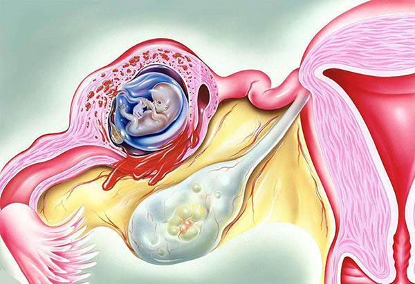 患有宫颈息肉会影响供卵代怀试管代生的成功率吗？听听美国不孕不育供卵代生医院医生是怎么说的吧