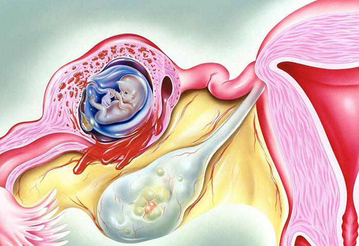患有宫颈息肉会影响供卵代怀试管代生的成功率吗？听听美国不孕不育供卵代生医院医生是怎么说的吧